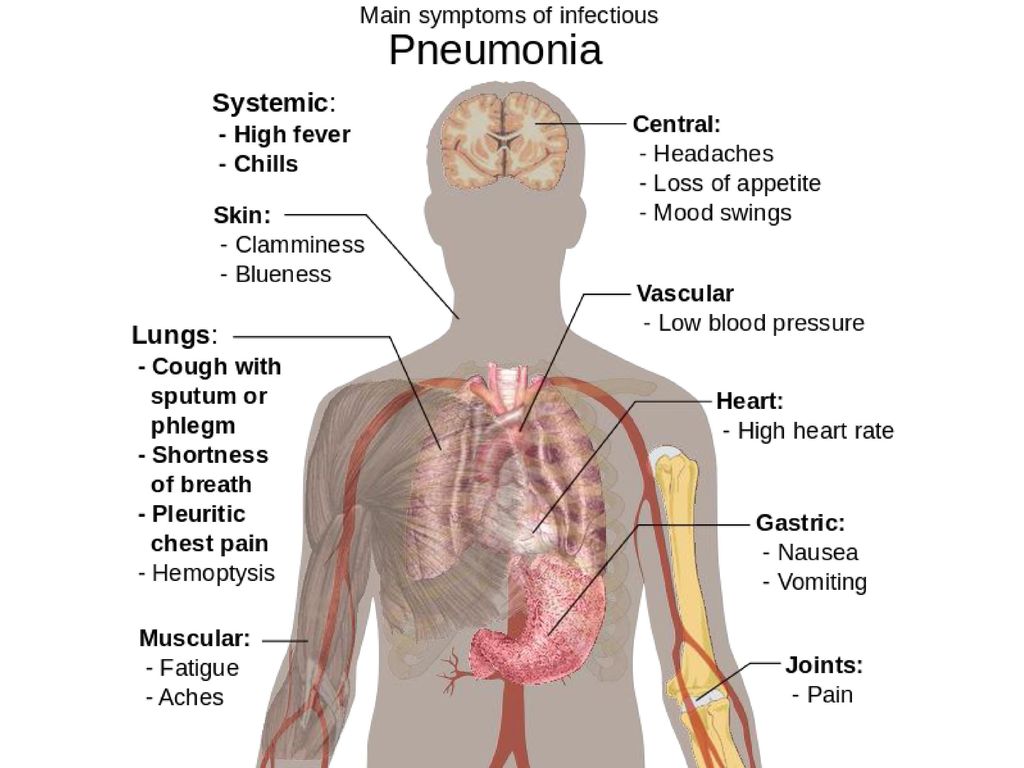 Главные симптомы пневмонии у подростков