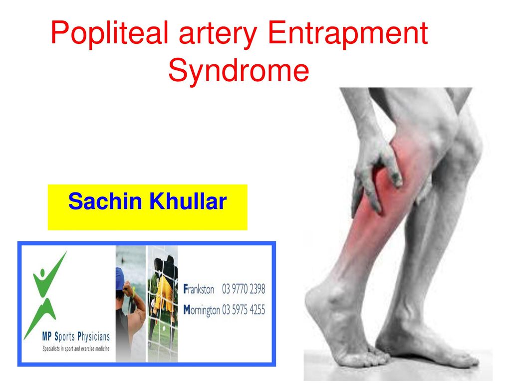 Ga op pad schrobben In detail Popliteal artery Entrapment Syndrome - ppt download
