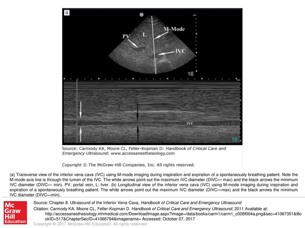 A Transverse View Of The Inferior Vena Cava Ivc Using M Mode Imaging During Inspiration And Expiration Of A Spontaneously Breathing Patient Note The Ppt Download