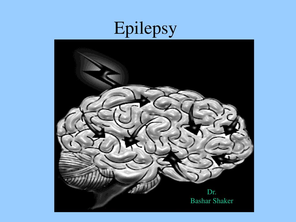 Epilepsy Epilepsy Dr. Bashar Shaker. - ppt download