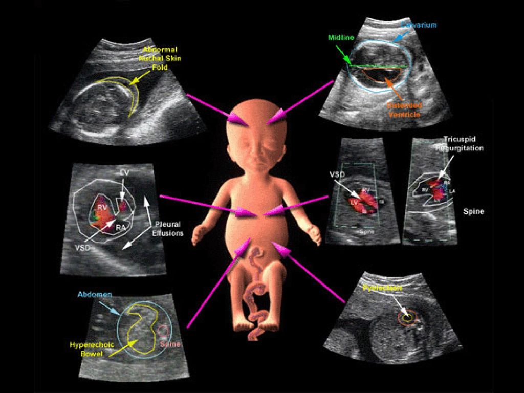 Доплер на каком сроке. УЗИ С доплером при беременности. Ультразвуковая допплерография маточно-плацентарного кровотока. УЗИ плода с доплером что это. Допплеровское УЗИ при беременности.