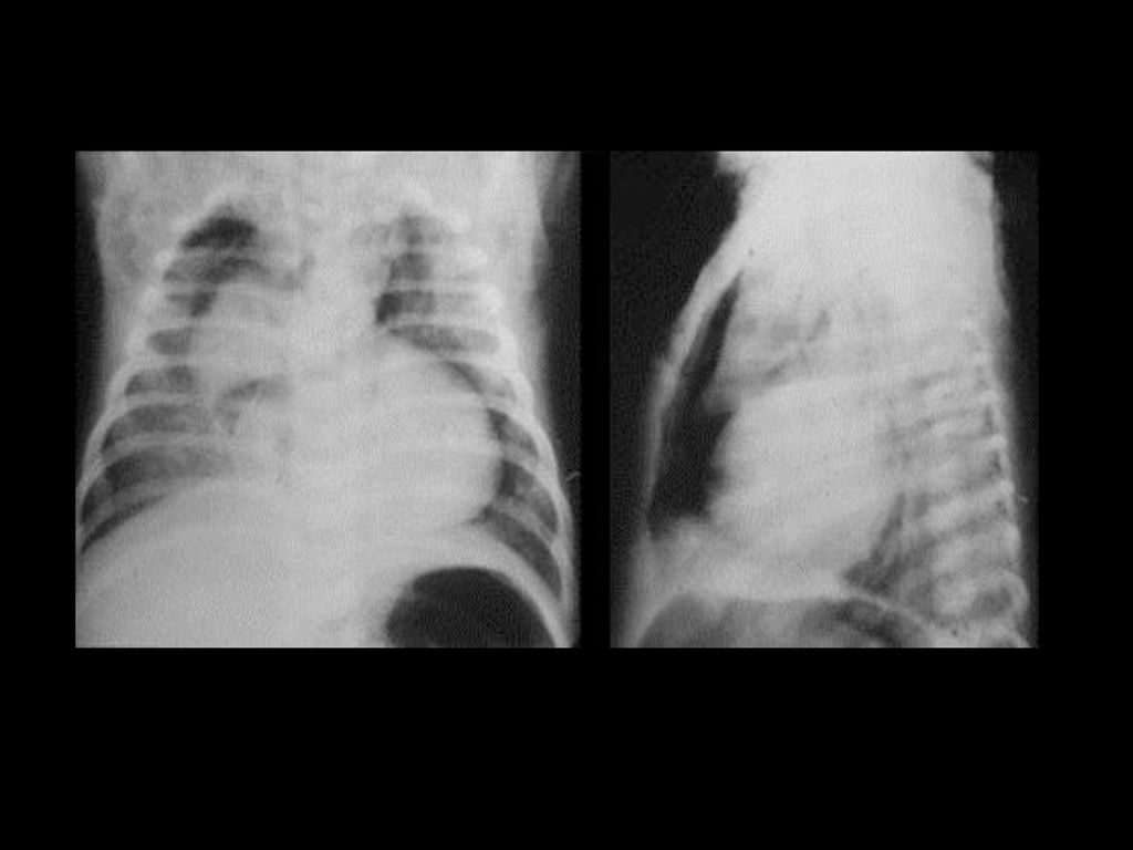 Radiografía de tórax pa y lateral para que sirve
