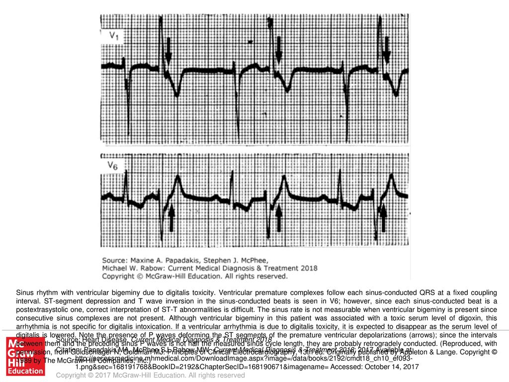 Sinus Rhythm With Ventricular Bigeminy Due To Digitalis Toxicity Ppt Download