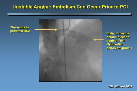 Unstable Angina: Embolism Can Occur Prior to PCI Thrombus in proximal RCA Stain of muscle before injection begins: TIMI Myocardial perfusion grade 1 CM.