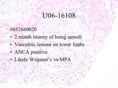 U06-16108 #652660020 2 month history of being unwell Vasculitic lesions on lower limbs ANCA positive Likely Wegener’s vs MPA.