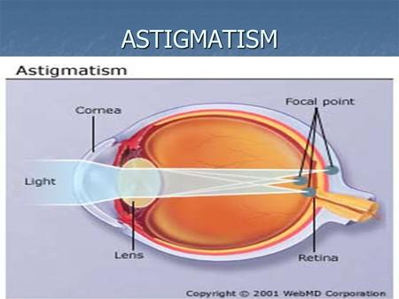 ASTIGMATISM. Astigmatism Astigmatism ASTIGMATISM MEANS THAT THE CORNEA IS OVAL, LIKE A FOOTBALL ASTIGMATISM MEANS THAT THE CORNEA IS OVAL, LIKE A FOOTBALL.