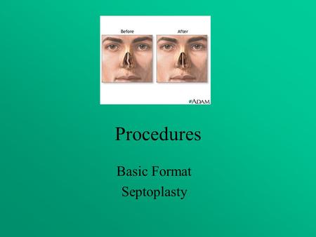 Basic Format Septoplasty