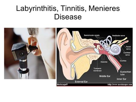 Labyrinthitis, Tinnitis, Menieres Disease