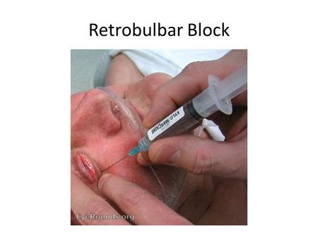 Retrobulbar Block. Introduction Commonly used for intraocular procedures including those involving cornea, lens, and anterior chamber. Goals of the retrobulbar.