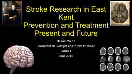 Stroke Research in East Kent Prevention and Treatment Present and Future Dr Tom Webb Consultant Neurologist and Stroke Physician EKHUFT June 2014.