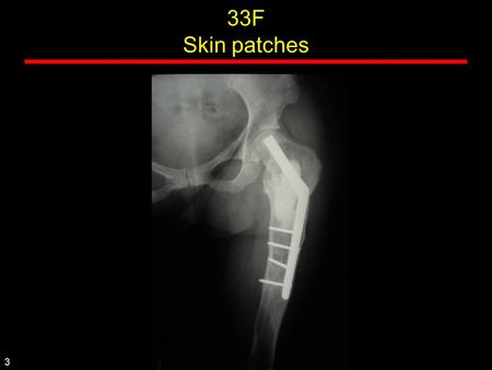 33F Skin patches 3. 2 1 McCune Albright 13M Bone Age - ESRD 2.