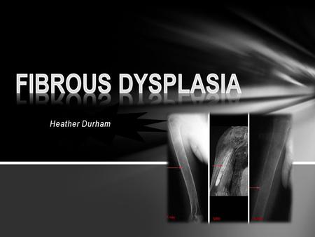Heather Durham. Fibrous Dysplasia occurs when bone gets destroyed and replaced with bone tissue What is it?
