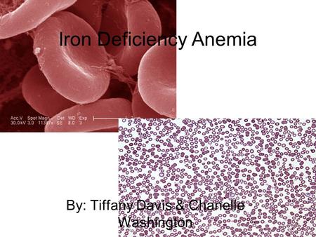 Iron Deficiency Anemia By: Tiffany Davis & Chanelle Washington.