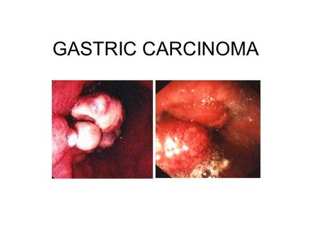 GASTRIC CARCINOMA. Pathophysiology Adenocarcinoma characterized as intestinal or diffuse Spreads through stomach into the gastric wall to the –Lymph nodes.