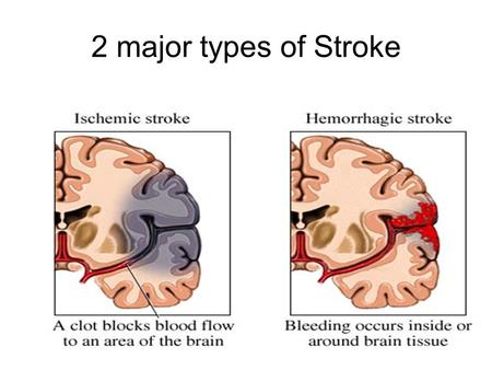 2 major types of Stroke.