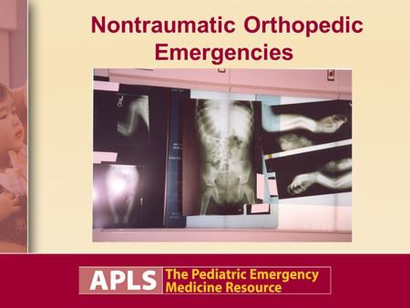 Nontraumatic Orthopedic Emergencies. Objectives Understand the pathophysiology of nontraumatic orthopedic conditions. Describe the management of nontraumatic.