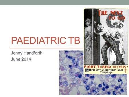 PAEDIATRIC TB Jenny Handforth June 2014. Overview Why is Paediatric TB important Epidemiology- know the patients Adult v child with TB - differences?