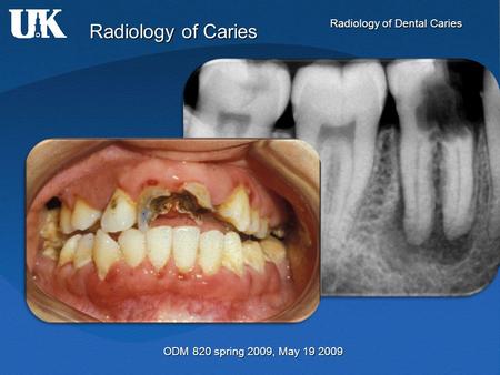 Radiology of Caries ODM 820 spring 2009, May 19 2009.