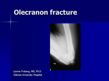Olecranon fracture Lonnie Froberg, MD, Ph.D Odense University Hospital.