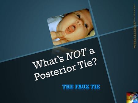 What’s NOT a Posterior Tie? 1 2 3 4 5 6 7 8 9 10 11 12 PV FV 15 16 17 18 19 20 21 Q.