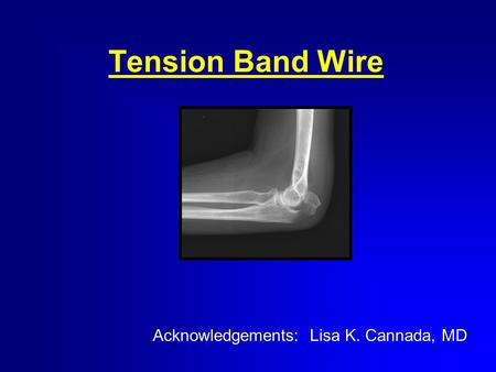 Tension Band Wire Acknowledgements: Lisa K. Cannada, MD.