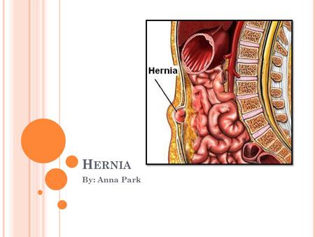 H ERNIA By: Anna Park. W HAT ’ S A H ERNIA ? A hernia is disease that occurs when a part of an organ (normally your intestines) bulges out towards your.