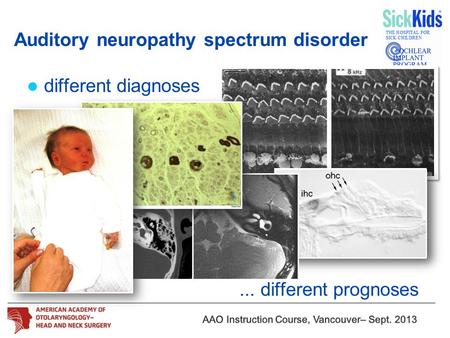 Different diagnoses... different prognoses Auditory neuropathy spectrum disorder.