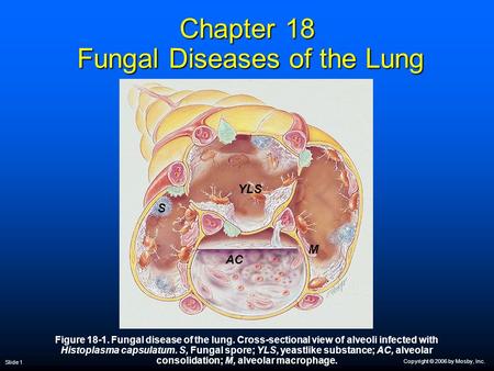 Copyright © 2006 by Mosby, Inc. Slide 1 Chapter 18 Fungal Diseases of the Lung Figure 18-1. Fungal disease of the lung. Cross-sectional view of alveoli.