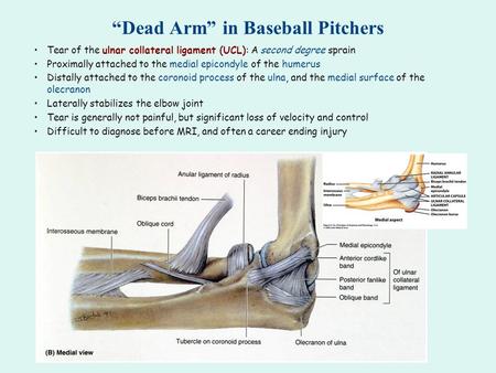 “Dead Arm” in Baseball Pitchers Tear of the ulnar collateral ligament (UCL): A second degree sprain Proximally attached to the medial epicondyle of the.