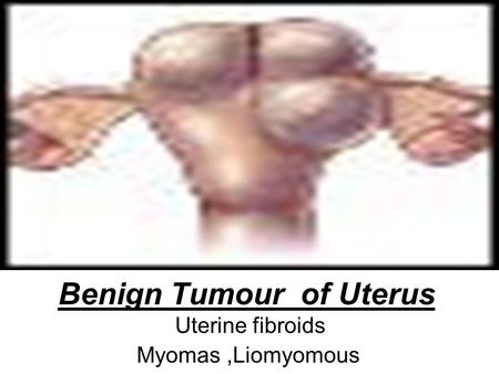 Benign Tumour of Uterus