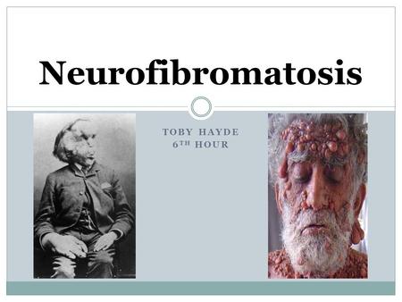 TOBY HAYDE 6 TH HOUR Neurofibromatosis. What is Neurofibromatosis? Neurofibromatosis (NF) is a genetic disorder that disturbs cell growth in the nervous.
