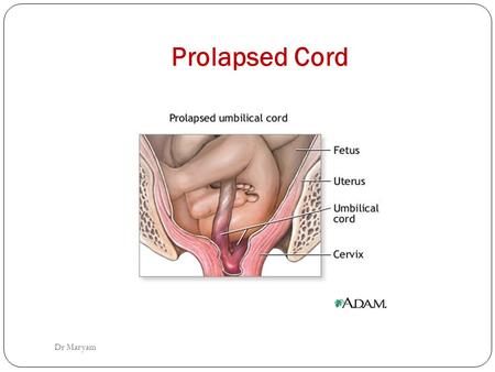 Prolapsed Cord Dr Maryam. Prolapsed Cord In order to understand about 'what is prolapsed cord', you can visualize the normal consequences in natural child.