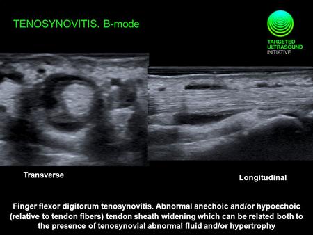 TENOSYNOVITIS. B-mode Transverse Longitudinal Finger flexor digitorum tenosynovitis. Abnormal anechoic and/or hypoechoic (relative to tendon fibers) tendon.