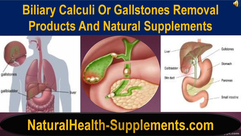 Biliary Calculi Or Gallstones Removal Products And Natural Supplements -  ppt download