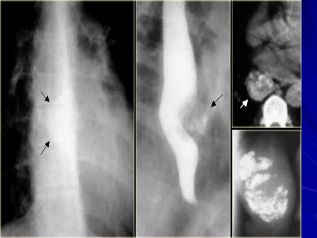3 пищевода. Лейомиома пищевода рентгенограмма. Лейомиома желудка рентген. Доброкачественная опухоль пищевода рентген.