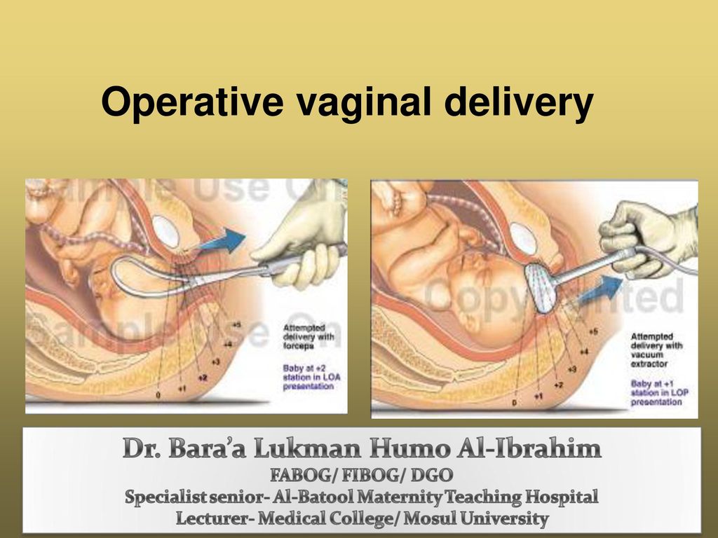 Operative vaginal delivery - ppt download
