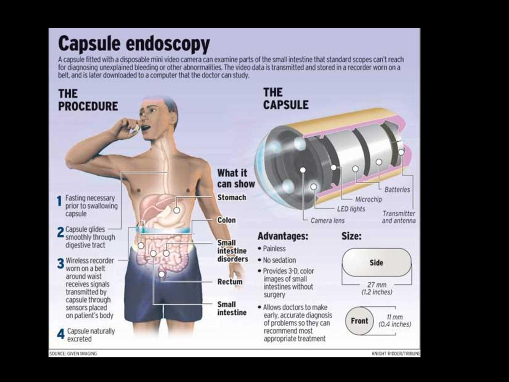 Cápsula endoscópica dieta