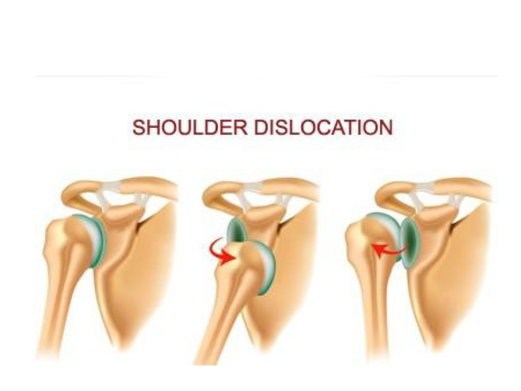 Вывих плечевого сустава. Подклювовидный вывих плечевого сустава. Подвывих плечевого сустава классификация. Плечелопаточный сустав,вывих. Передний подклювовидный вывих плеча.