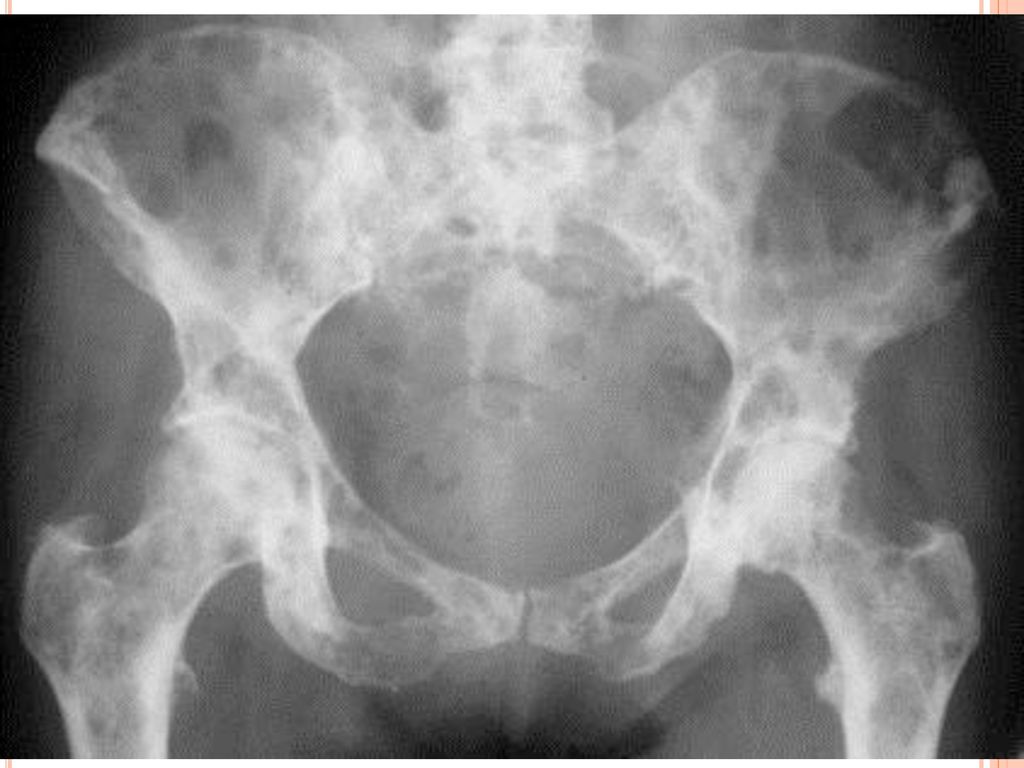 Метастатическое поражение кости. Миеломная болезнь кости таза рентген. Остеобластические метастазы рентген. Миелома бедренной кости рентген. Миеломная болезнь тазовых костей рентген.