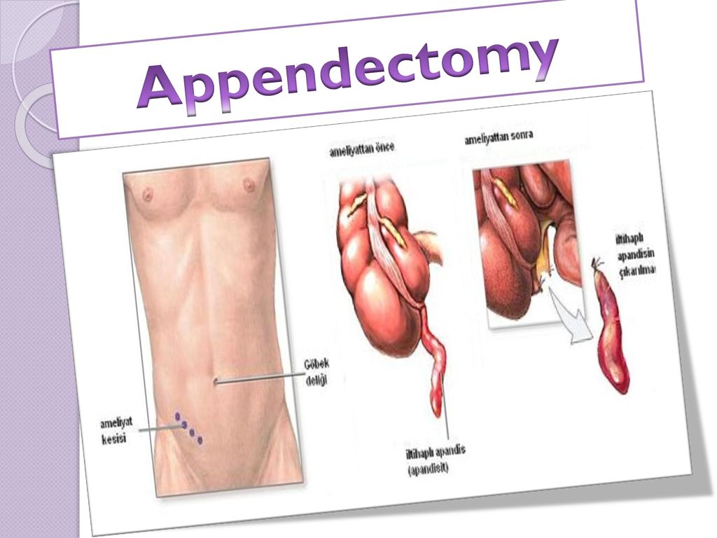 Back to basics: A meta-analysis of stump management during open  appendicectomy for uncomplicated acute appendicitis