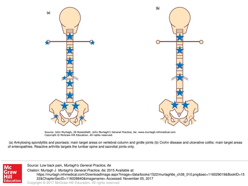 a) Ankylosing spondylitis and psoriasis: main target areas on vertebral  column and girdle joints (b) Crohn disease and ulcerative colitis: main  target. - ppt download