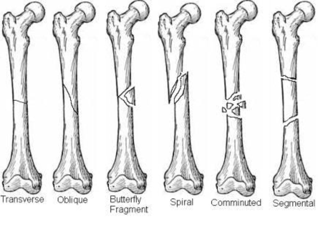 Поставить на 4 кости. Врожденные и приобретенные переломы. Врожденные переломы костей. Внутриутробные переломы костей скелета. Переломы костей человека в картинках.