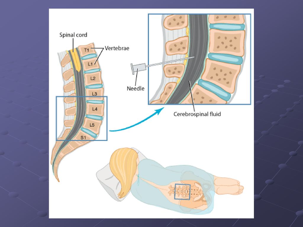 Пункция спинного мозга. Люмбальная пункция ликвора. Люмбальная пункция спинного мозга. Люмбальная пункция позвонки. Техника пункции ликвора.