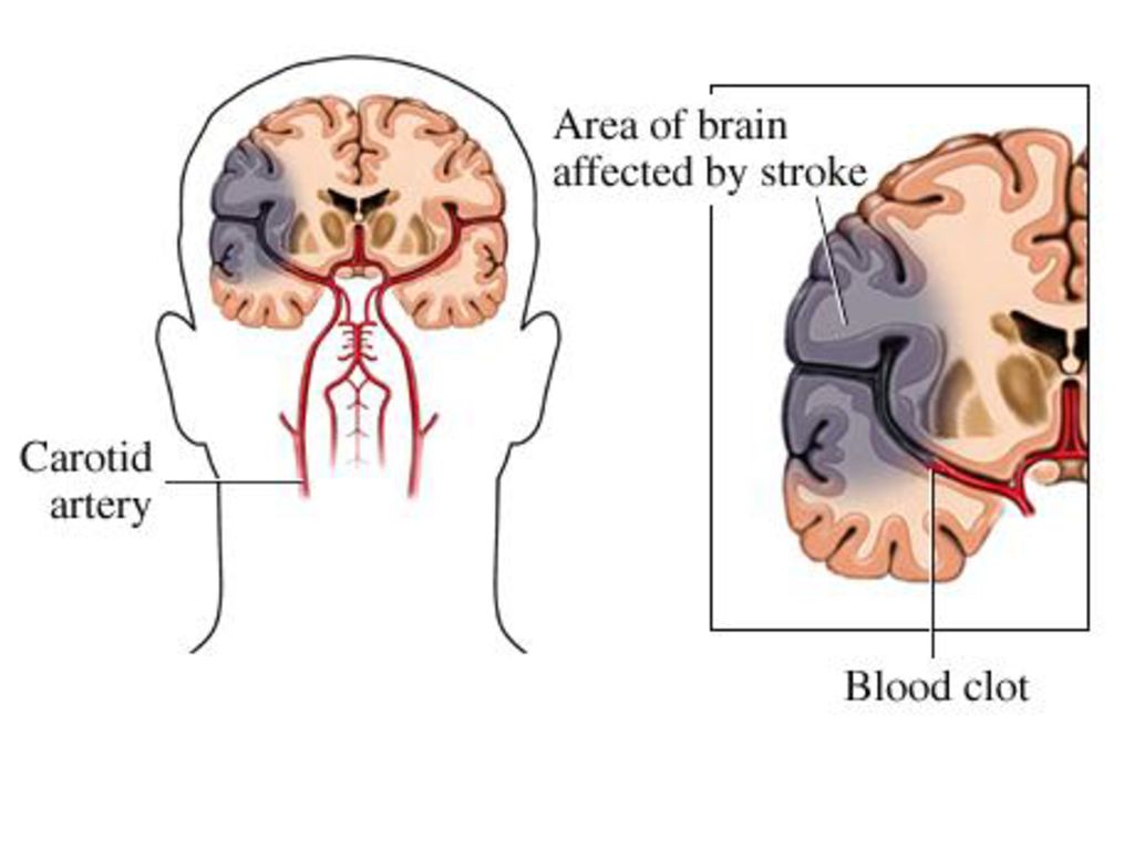 Последствия ишемической атаки мозга