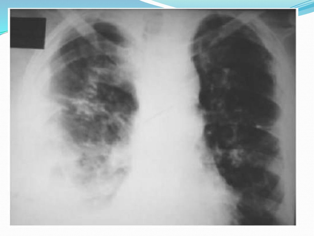 Прогрессирование туберкулеза. Экссудативный туберкулез легкого. Диссеминированный туберкулез и пневмония.