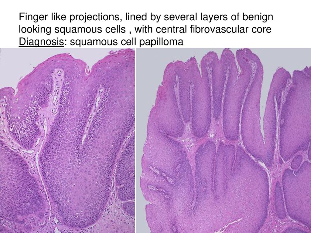 squamous cell papilloma slideshare)