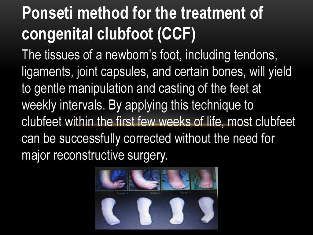 Ponseti Method For The Treatment Of Congenital Clubfoot Ccf Ppt Download