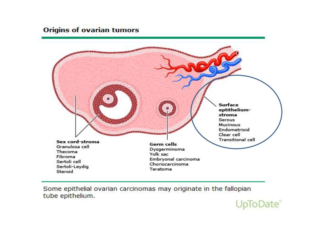 Biomarkers of ovarian cancer and cysts - ppt download