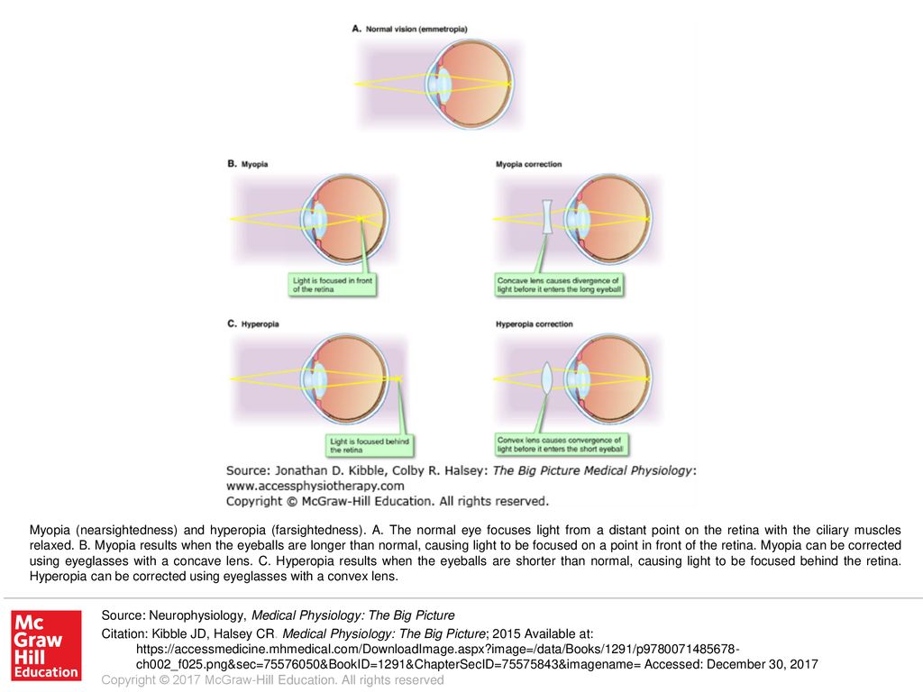 myopia és hyperopia lecke látóideg gyulladása