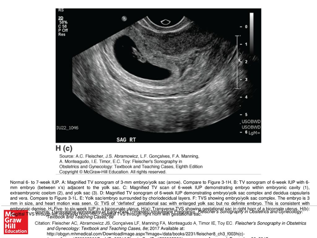 Normal 6 To 7 Week Iup A Magnified Tv Sonogram Of 3 Mm Embryo Yolk Sac Arrow Compare To Figure 3 1h B Tv Sonogram Of 6 Week Iup With 6 Mm Embryo Ppt Download